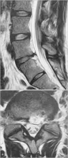 治疗后一个月后MRI