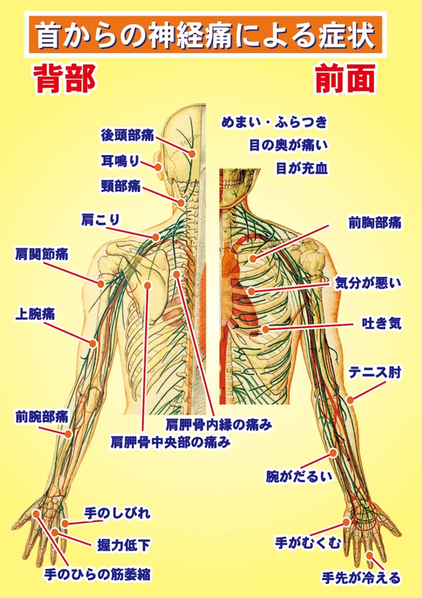 首からの神経痛による症状