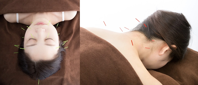 顔面・頚部の総合鍼治療で美顔の輝きと肩こり解消を