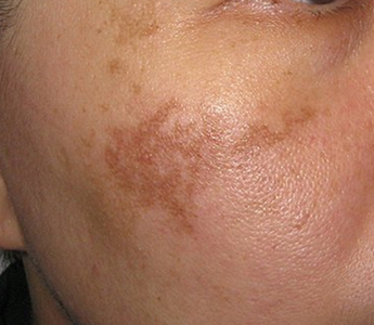 美容皮膚科 犬山市 扶桑町の皮膚科 清水由起乃