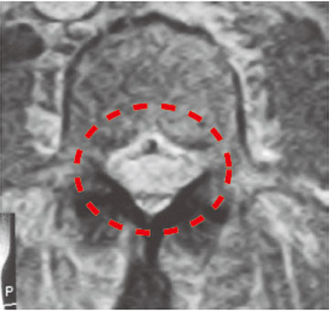 正常な方の広い脊柱管MRI像で示す