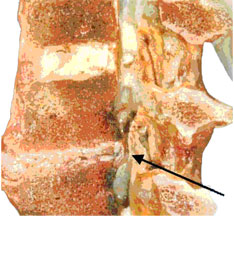 椎間板・黄色靭帯・椎間関節の肥大増殖