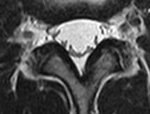 〈図：正常〉丸く大きく写った正常な神経（MRI画像）