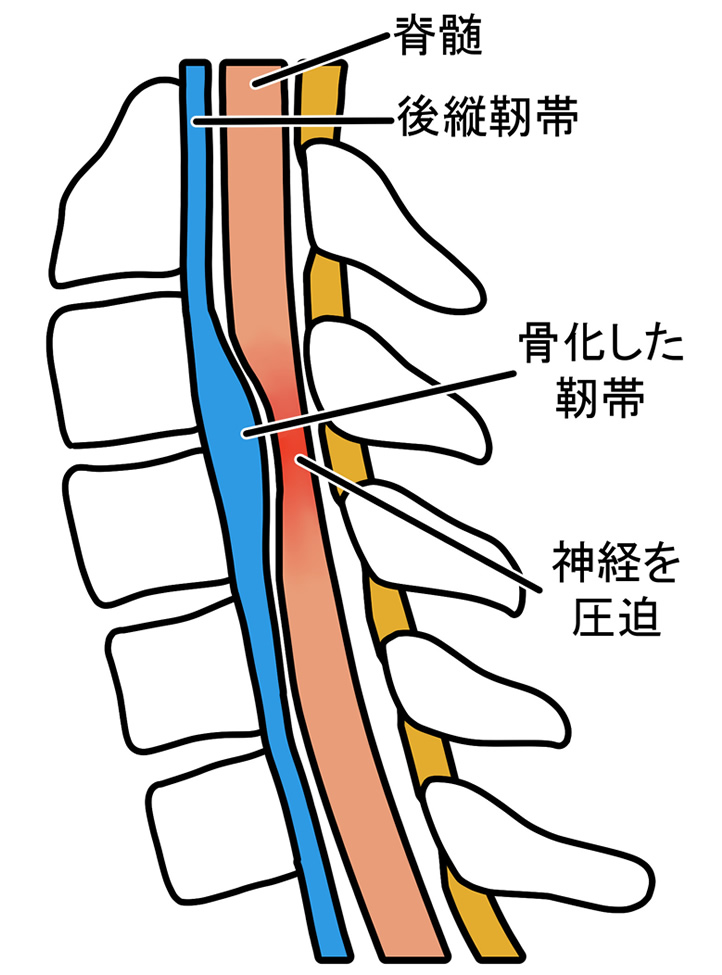 後縦靭帯骨化症